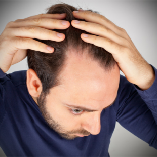 Chute de cheveux chez l'homme